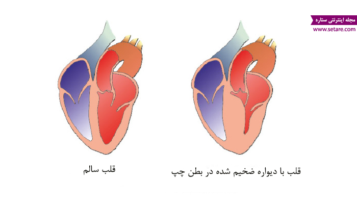 علت ضخیم شدن دیواره قلب چیست و چگونه درمان می‌شود؟